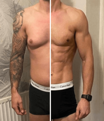 Male chest reduction gynecomastia